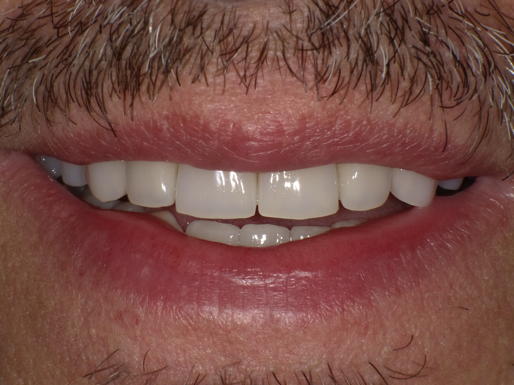 Völlig anderes Auftreten mit total positiver Ausstrahlung; Oberkiefer Stegversorgung auf 6 Implantaten und Unterkiefer vollkeramische Kronen und Brücken